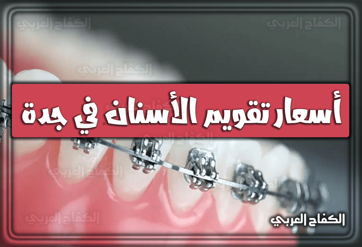 أسعار تقويم الأسنان في جدة 2023 السعودية 1444